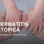 Dermatitis atópica