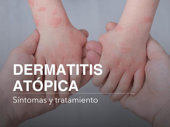 Dermatitis atópica